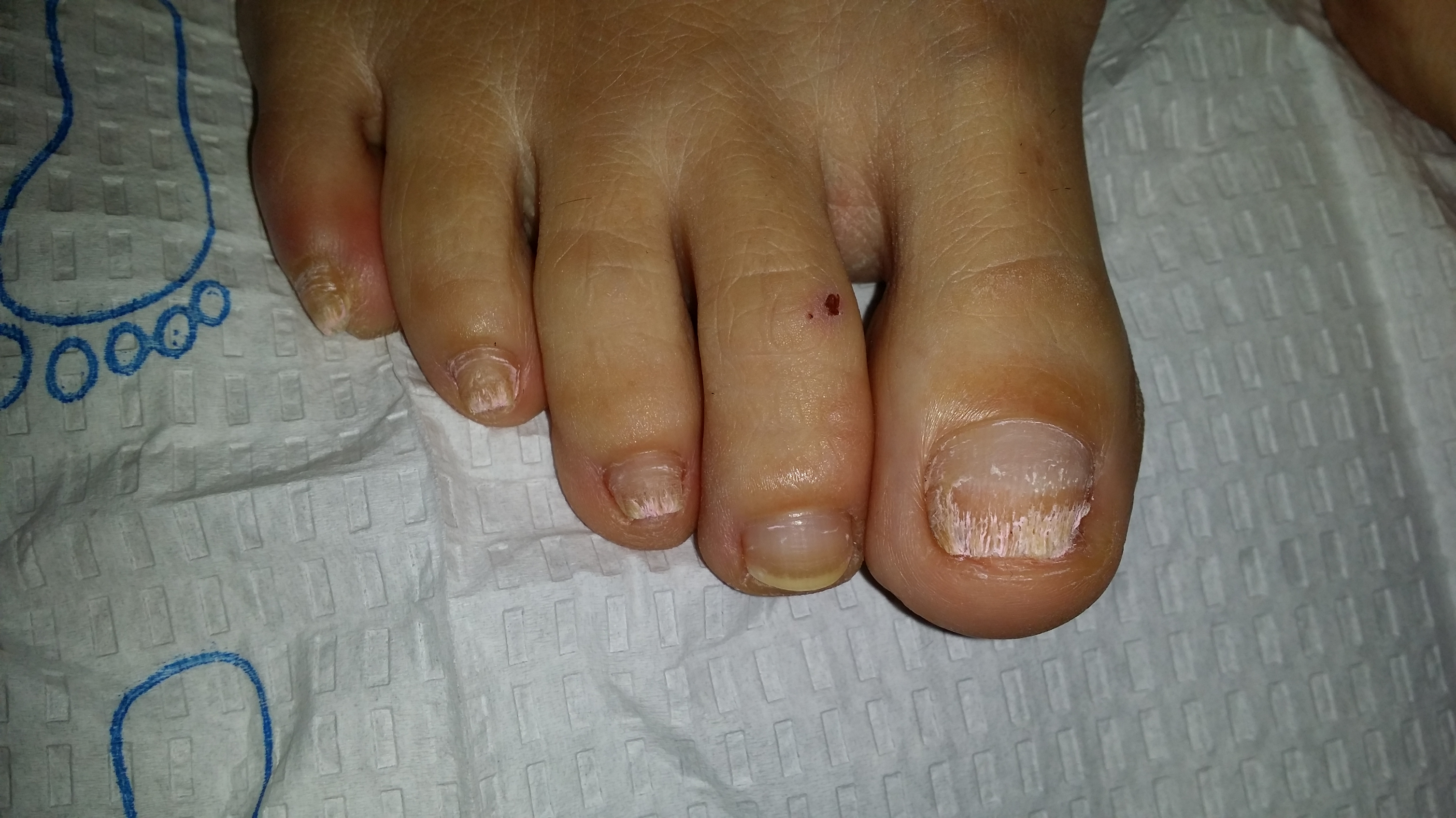 mild toe fungus treatment
