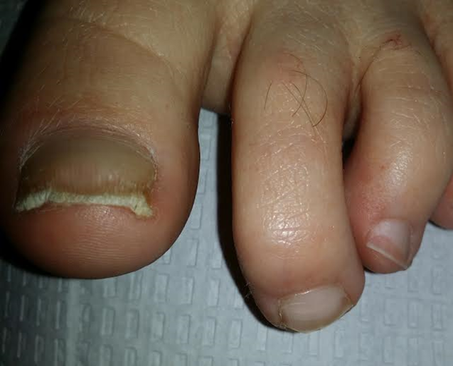 How to Tell if You Have a Toenail Fungus - Colorado Center of
