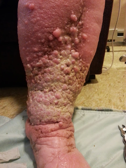 severe edema