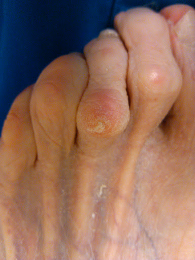 What causes hammertoes and corns?