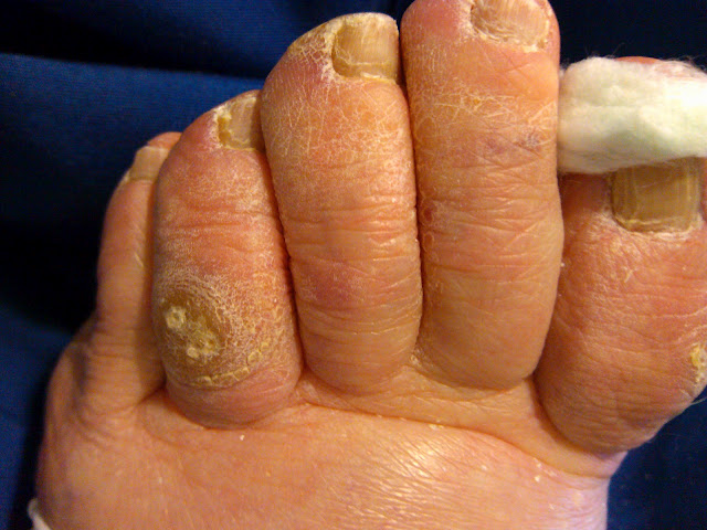 What causes hammertoes and corns?