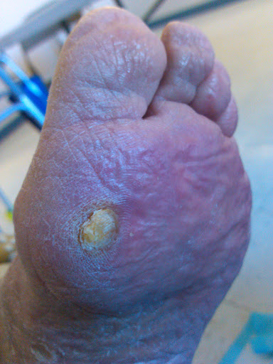 https://www.totallyfeet.net/foot-facts/foot-dermatology/painful-calluses/ipk/