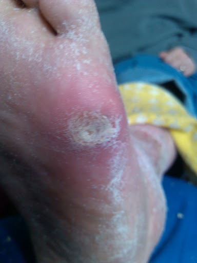 https://www.totallyfeet.net/foot-facts/foot-dermatology/painful-calluses/ipk1/