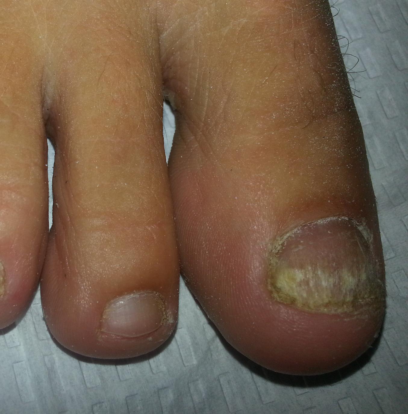 Ingrown Toenail Fungus Treatment in Fort Collins Colorado